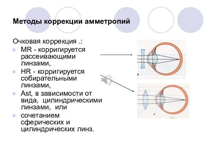 Методы коррекции амметропий Очковая коррекция .: MR - корригируется рассеивающими линзами,