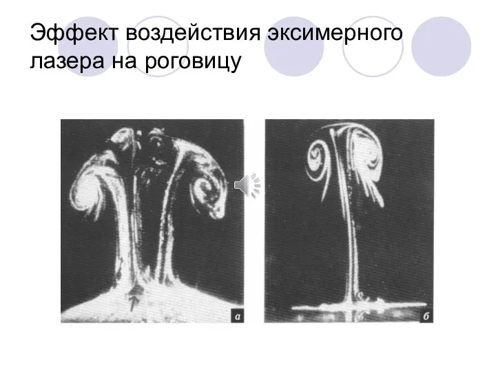 Эффект воздействия эксимерного лазера на роговицу