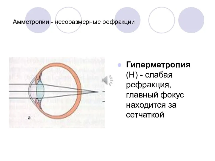 Амметропии - несоразмерные рефракции Гиперметропия (Н) - слабая рефракция, главный фокус находится за сетчаткой