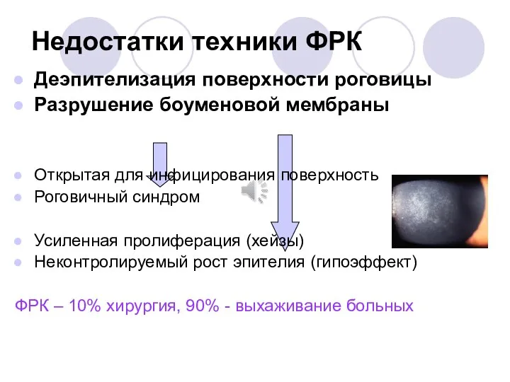 Недостатки техники ФРК Деэпителизация поверхности роговицы Разрушение боуменовой мембраны Открытая для