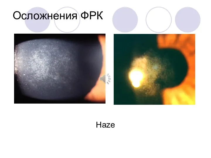 Осложнения ФРК Haze