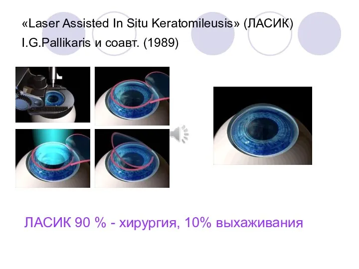 «Laser Assisted In Situ Keratomileusis» (ЛАСИК) I.G.Pallikaris и соавт. (1989) ЛАСИК