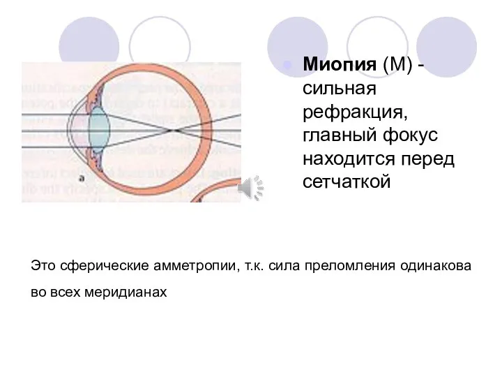 Это сферические амметропии, т.к. сила преломления одинакова во всех меридианах Миопия