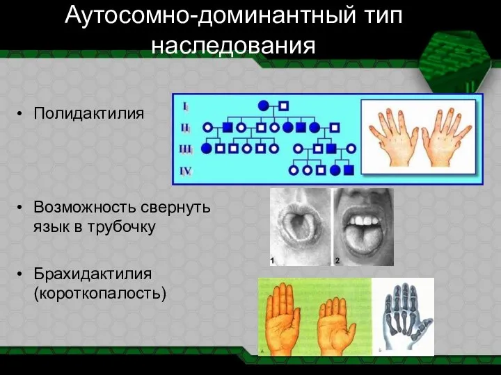 Аутосомно-доминантный тип наследования Полидактилия Возможность свернуть язык в трубочку Брахидактилия (короткопалость)