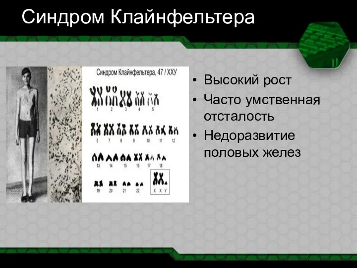 Синдром Клайнфельтера Высокий рост Часто умственная отсталость Недоразвитие половых желез