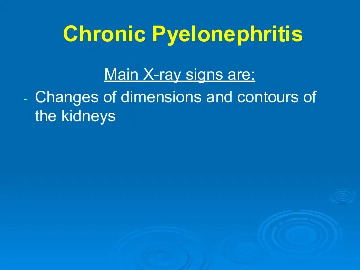 Chronic Pyelonephritis Main X-ray signs are: Changes of dimensions and contours of the kidneys