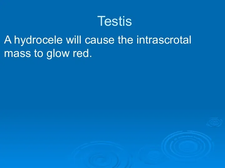 Testis A hydrocele will cause the intrascrotal mass to glow red.