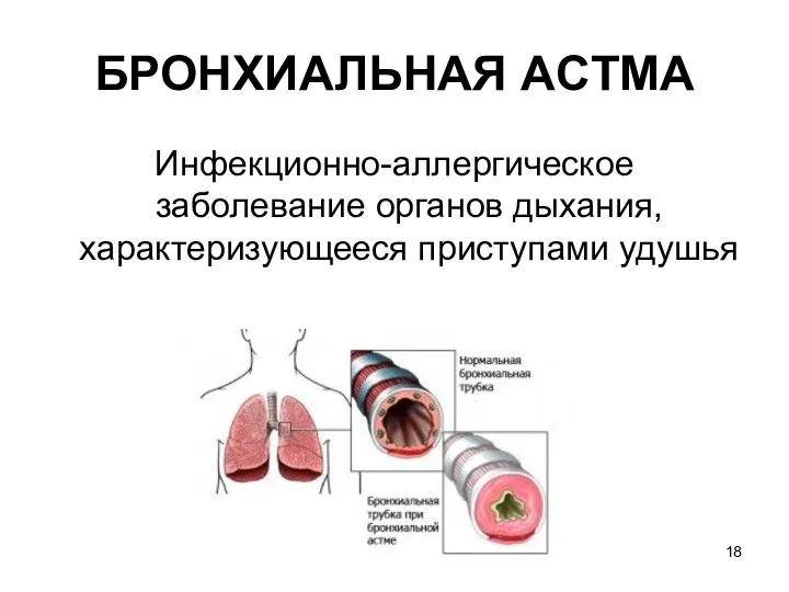 БРОНХИАЛЬНАЯ ACTМA Инфекционно-аллергическое заболевание органов дыхания, характеризующееся приступами удушья