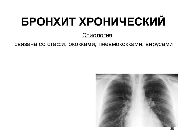 БРОНХИТ ХРОНИЧЕСКИЙ Этиология связана со стафилококками, пневмококками, вирусами