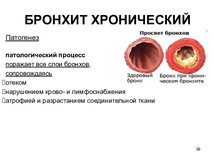 БРОНХИТ ХРОНИЧЕСКИЙ Патогенез патологический процесс поражает все слои бронхов, сопровождаясь отеком