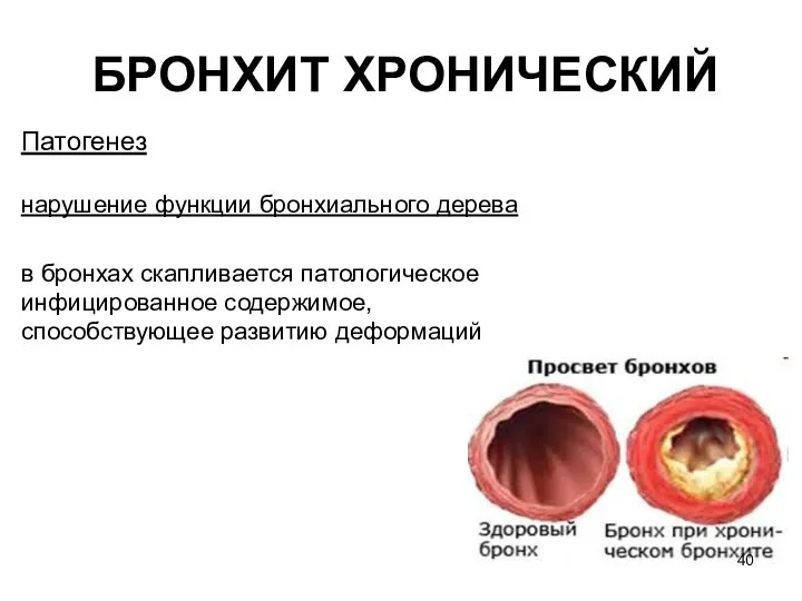 БРОНХИТ ХРОНИЧЕСКИЙ Патогенез нарушение функции бронхиального дерева в бронхах скапливается патологическое инфицированное содержимое, способствующее развитию деформаций