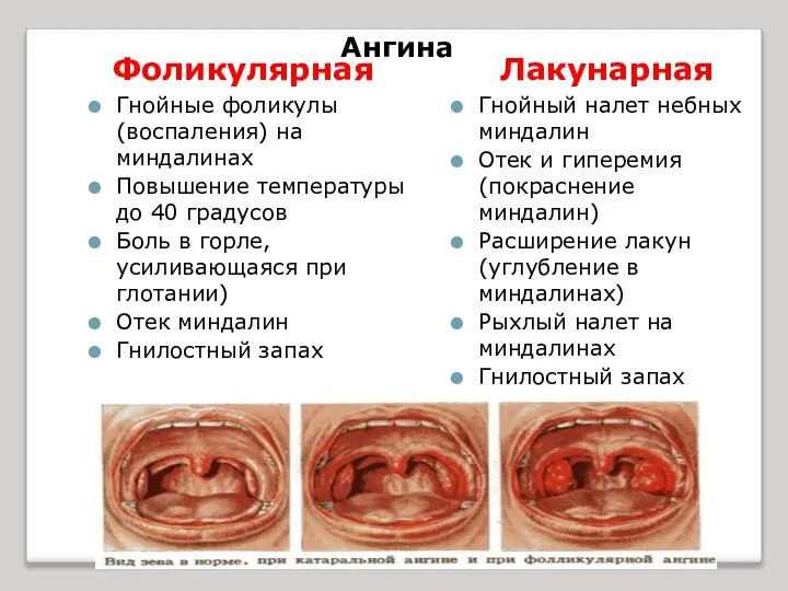 Ангина Фоликулярная Гнойные фоликулы(воспаления) на миндалинах Повышение температуры до 40 градусов