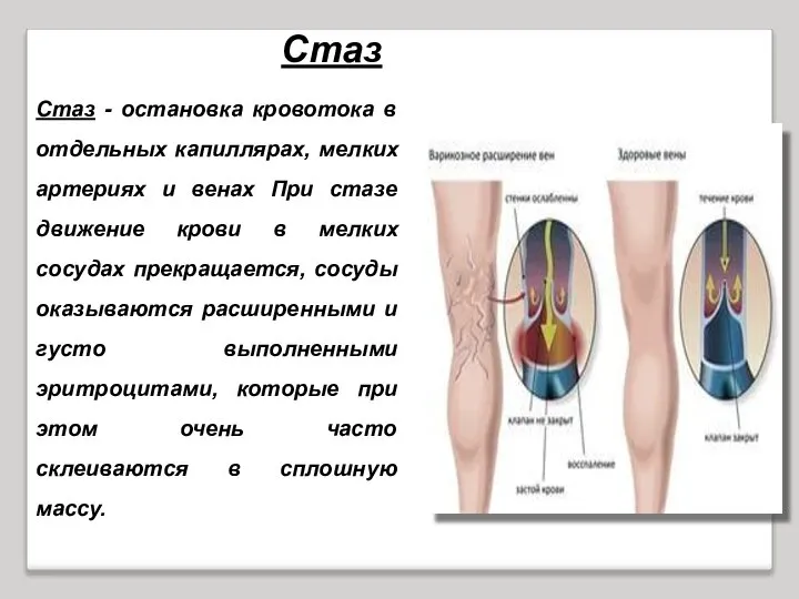 Стаз - остановка кровотока в отдельных капиллярах, мелких артериях и венах