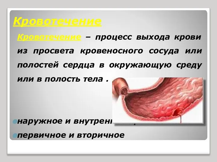 Кровотечение Кровотечение – процесс выхода крови из просвета кровеносного сосуда или