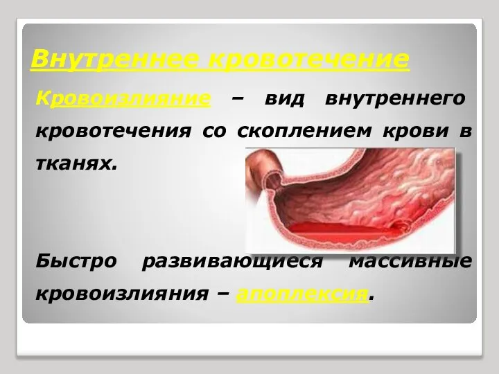 Внутреннее кровотечение Кровоизлияние – вид внутреннего кровотечения со скоплением крови в