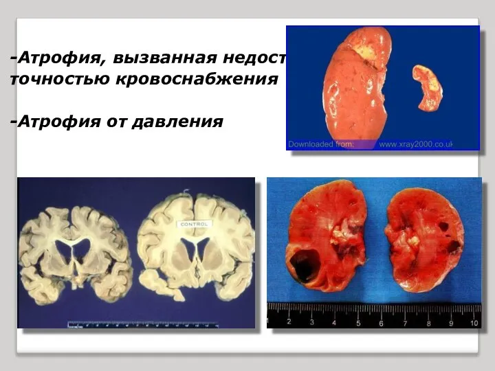 -Атрофия, вызванная недоста- точностью кровоснабжения -Атрофия от давления