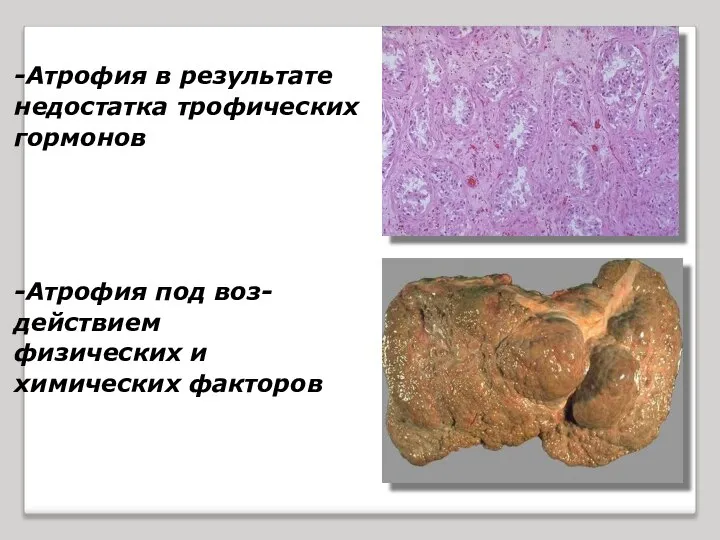 -Атрофия в результате недостатка трофических гормонов -Атрофия под воз- действием физических и химических факторов