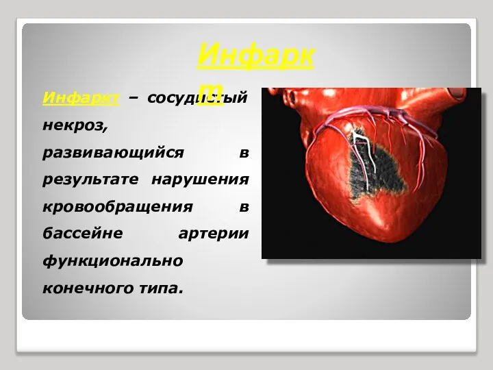 Инфаркт – сосудистый некроз, развивающийся в результате нарушения кровообращения в бассейне артерии функционально конечного типа. Инфаркт