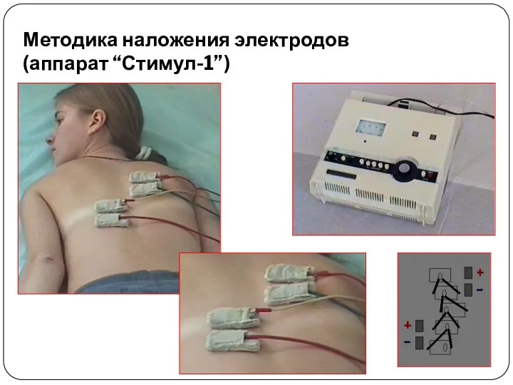 Методика наложения электродов (аппарат “Стимул-1”)