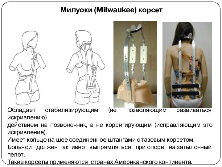 Милуоки (Milwaukee) корсет Обладает стабилизирующим (не позволяющим развиваться искривлению) действием на