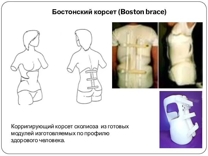 Корригирующий корсет сколиоза из готовых модулей изготовляемых по профилю здорового человека. Бостонский корсет (Boston brace)