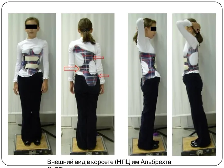Внешний вид в корсете (НПЦ им.Альбрехта С-Пб)