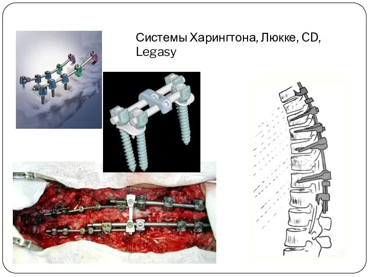 Системы Харингтона, Люкке, CD, Legasy