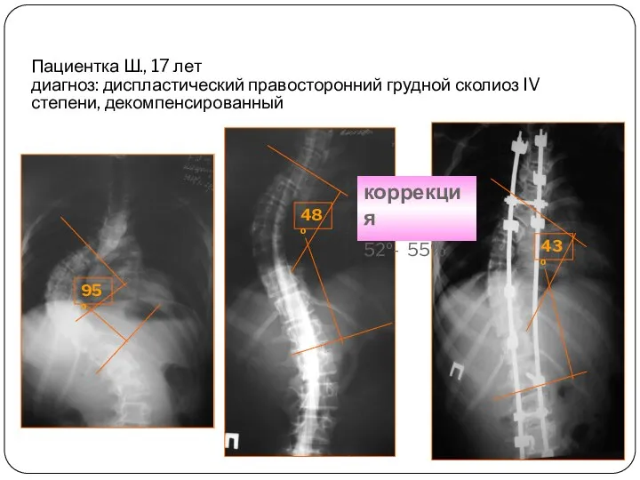 Пациентка Ш., 17 лет диагноз: диспластический правосторонний грудной сколиоз IV степени, декомпенсированный коррекция 52º- 55%