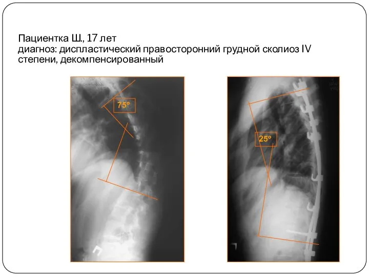 Пациентка Ш., 17 лет диагноз: диспластический правосторонний грудной сколиоз IV степени, декомпенсированный