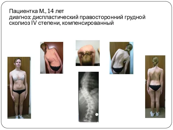 Пациентка М., 14 лет диагноз: диспластический правосторонний грудной сколиоз IV степени, компенсированный