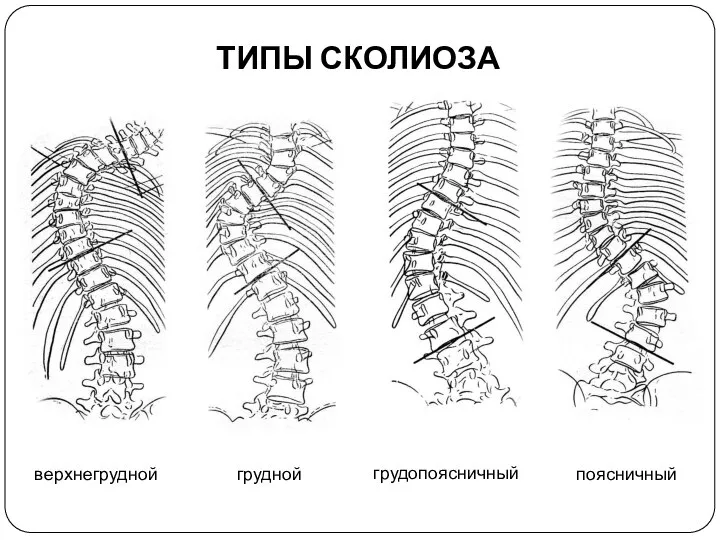 ТИПЫ СКОЛИОЗА верхнегрудной грудной грудопоясничный поясничный