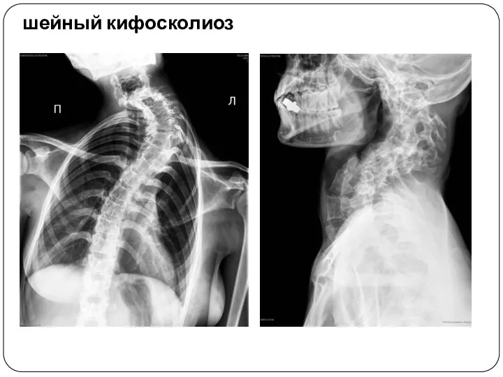 шейный кифосколиоз