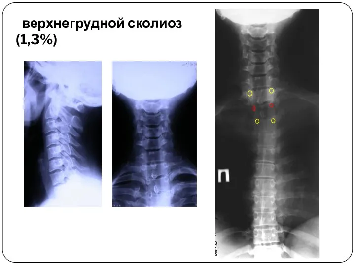 верхнегрудной сколиоз (1,3%)