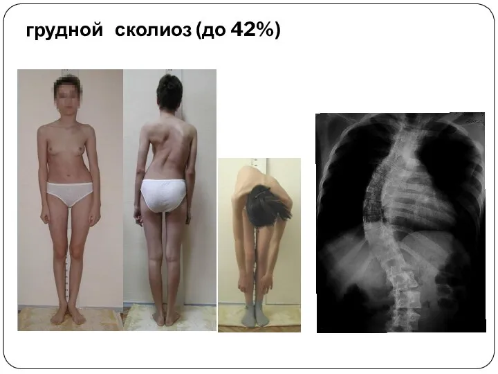 грудной сколиоз (до 42%)