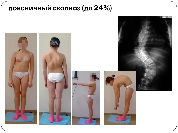 поясничный сколиоз (до 24%)