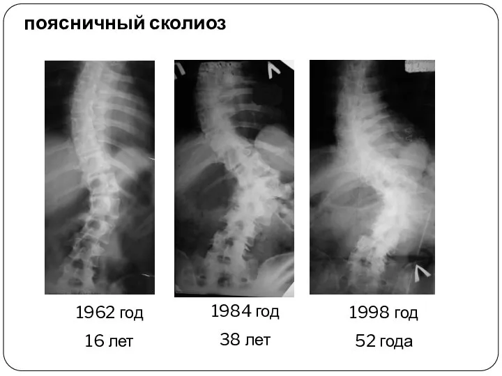 поясничный сколиоз 1962 год 16 лет 1984 год 38 лет 1998 год 52 года