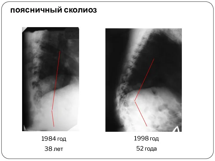 1984 год 38 лет 1998 год 52 года поясничный сколиоз