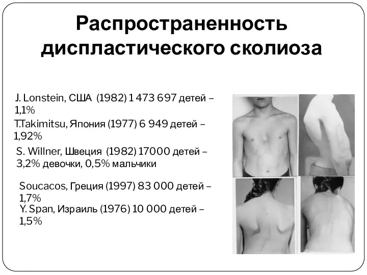 Распространенность диспластического сколиоза J. Lonstein, США (1982) 1 473 697 детей