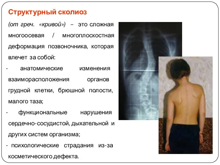 Структурный сколиоз (от греч. «кривой») – это сложная многоосевая / многоплоскостная