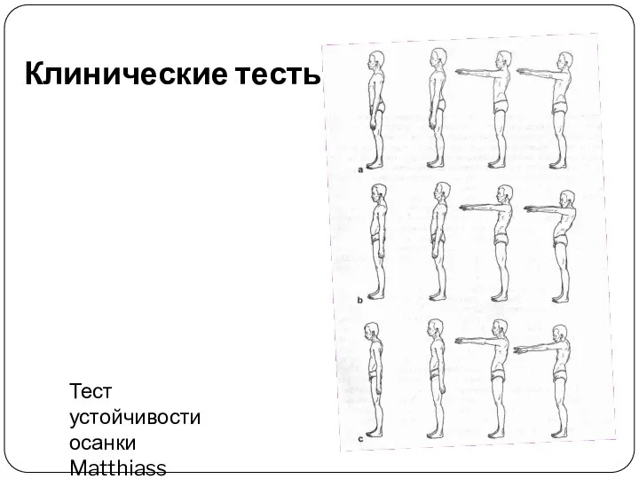 Клинические тесты Тест устойчивости осанки Matthiass