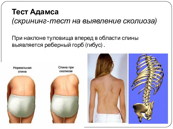 Тест Адамса (скрининг-тест на выявление сколиоза) При наклоне туловища вперед в