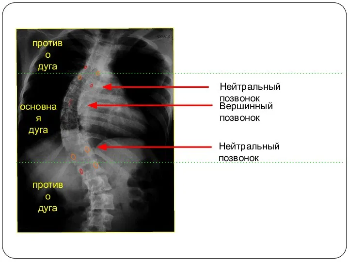 Нейтральный позвонок Вершинный позвонок Нейтральный позвонок основная дуга противо дуга противо дуга