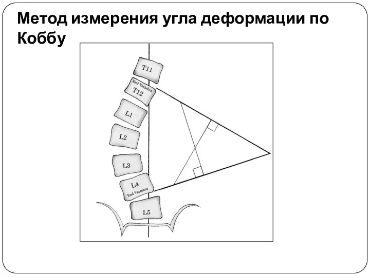 Метод измерения угла деформации по Коббу