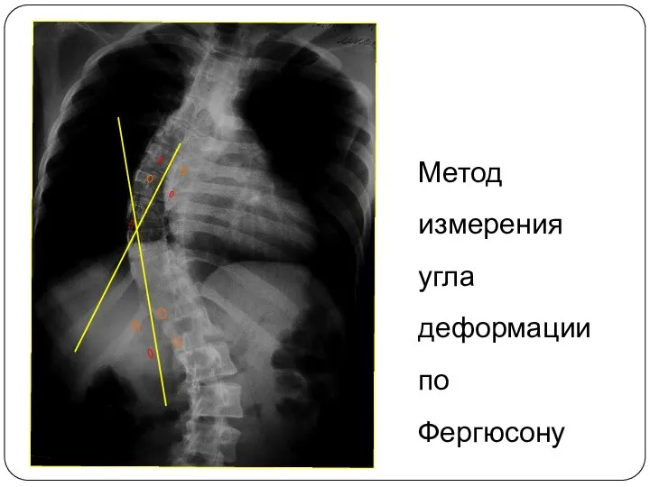 Метод измерения угла деформации по Фергюсону