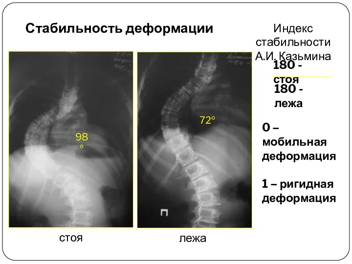 Стабильность деформации 98º 72º стоя лежа 180 - стоя 180 -