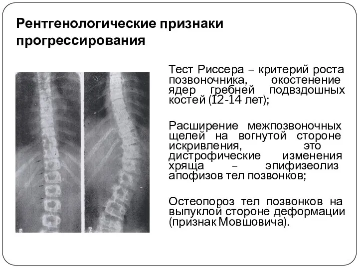 Рентгенологические признаки прогрессирования Тест Риссера – критерий роста позвоночника, окостенение ядер