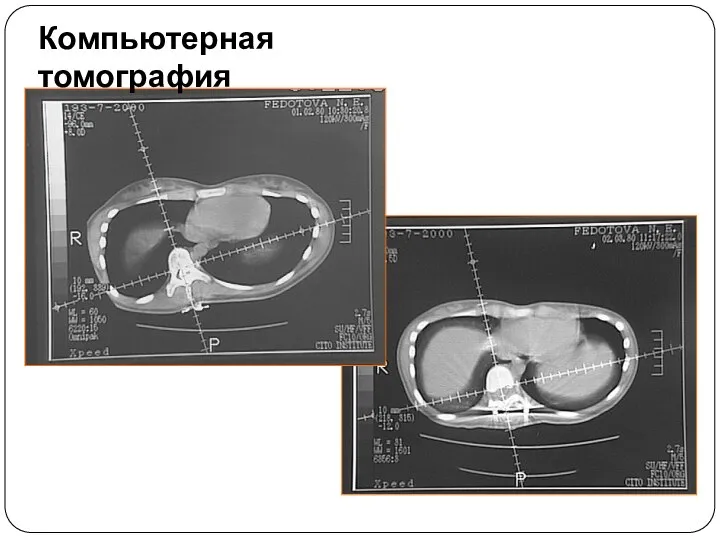 Компьютерная томография