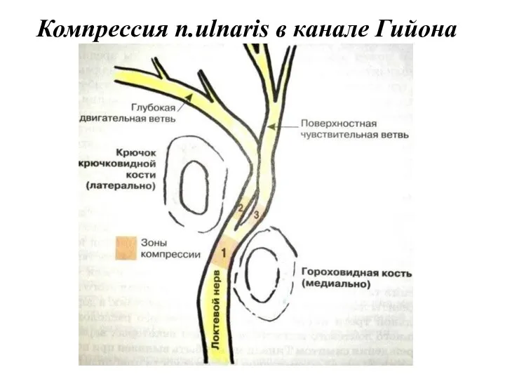 Компрессия n.ulnaris в канале Гийона