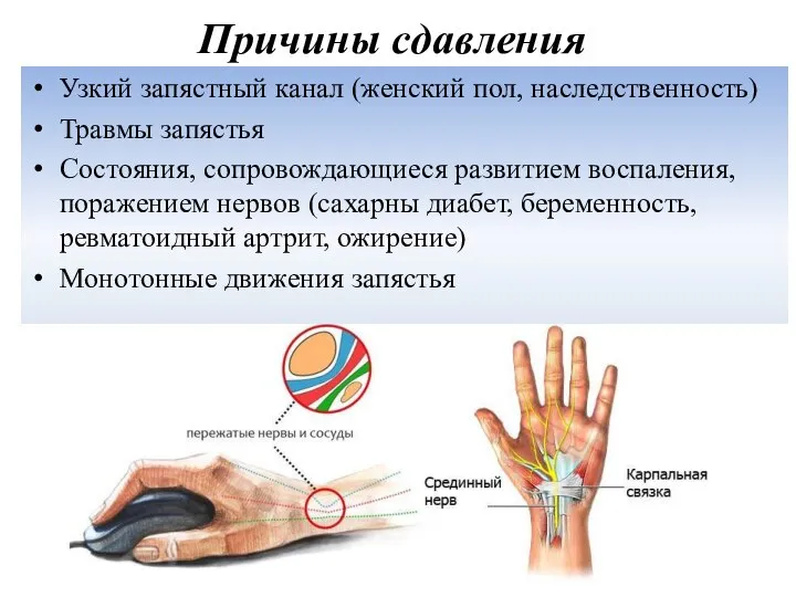 Причины сдавления Узкий запястный канал (женский пол, наследственность) Травмы запястья Состояния,