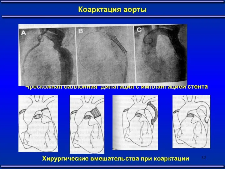 Коарктация аорты Чрескожная баллонная дилатация с имплантацией стента Хирургические вмешательства при коарктации